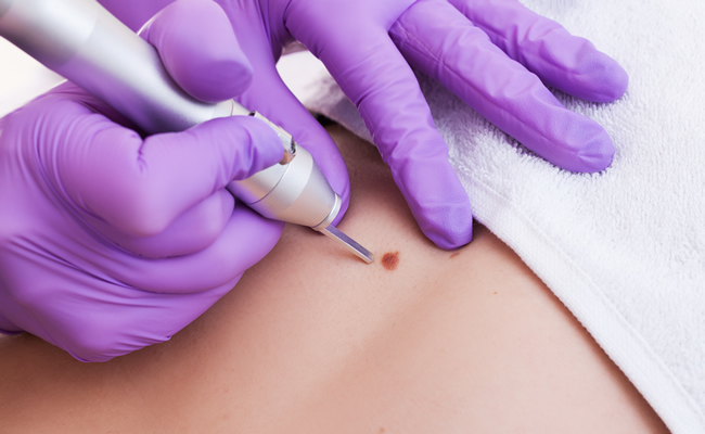cryopen treatments